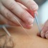 L'acupuncture est-elle efficace ?